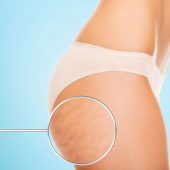 Trattamento Cellulite | Centro Benessere Licia Trattamento Cellulite | Centro Benessere Licia